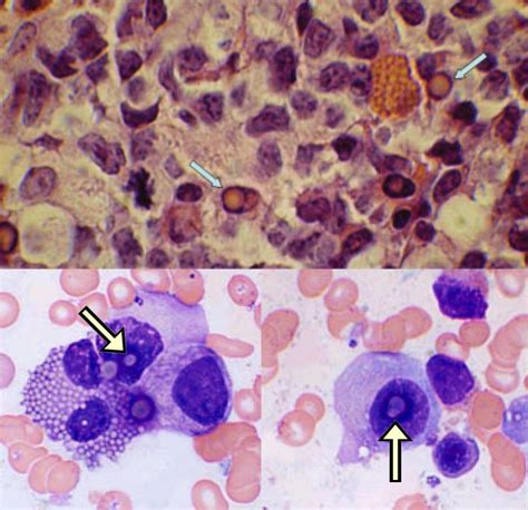 Dutcher bodies of Plasma cells dyscrasias Reference http ...