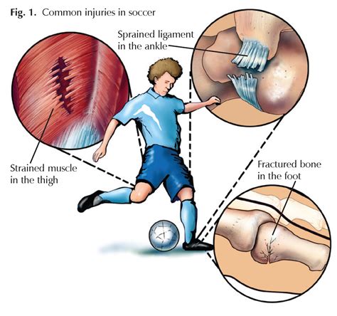 Soccer Players: Sprains, Strains, and Breaks - Hughston Clinic