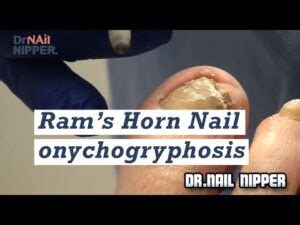 Ram's Horn Nail (onychogryphosis) trimming in podiatry office - Dr Nail ...