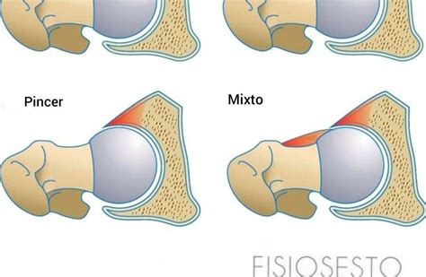 Choque femoroacetabular, tratamiento y ejercicios en fisioterapia.