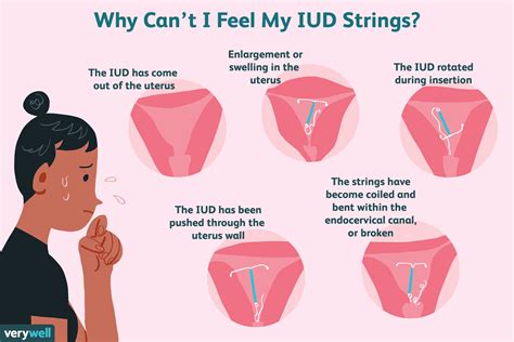 Can't Feel IUD Strings: Signs It's Missing or Lost, What to Do