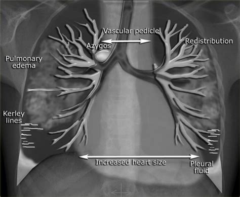 Heart Failure Chest X Ray Signs