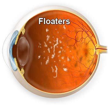 Floaters — Wooldridge Optometry