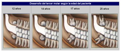 Que tomar para el dolor de muelas del juicio – Dolor de Muelas