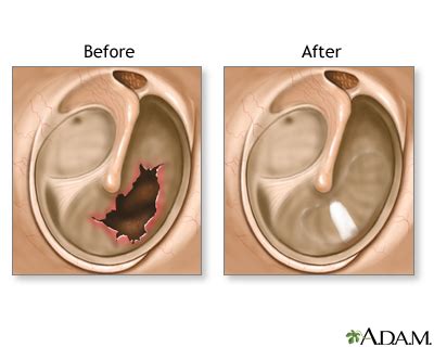 Eardrum repair. Causes, symptoms, treatment Eardrum repair