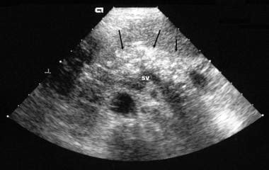 Chronic Pancreatitis Imaging: Practice Essentials, Radiography ...