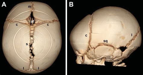 Pediatric Craniosynostosis: UF Pediatric Neurosurgery » Pediatric ...