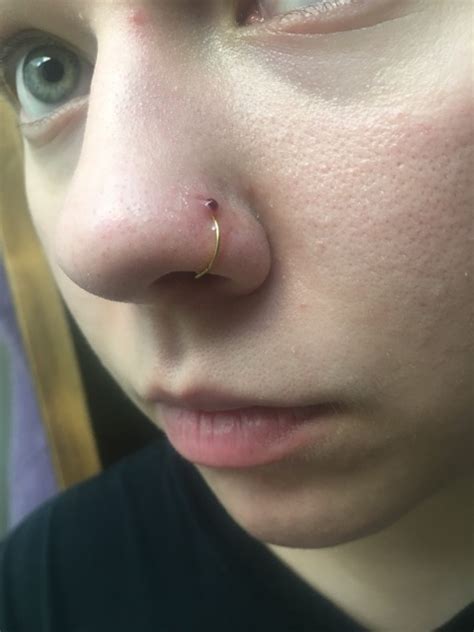 Nose piercing bump - Glow Community