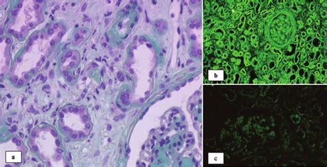 Light chain deposition disease in the native kidney. a: Masson ...