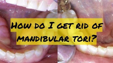 Understanding Mandibular Tori: Causes, Treatment, and Concerns