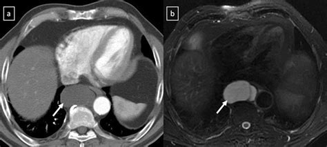 Duplication cyst in a 42year-old asymptomatic man. a Contrast-enhanced ...