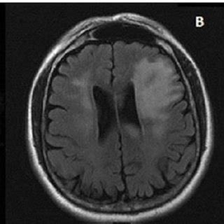 MR Brain: (A) Axial Diffusion Weighted Image (DWI) showing restricted ...