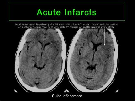 CT Imaging of Cerebral Ischemia and Infarction