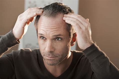 7 Common Male Hair Loss Causes