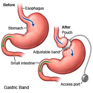 Adjustable Gastric Band Surgery - What You Need to Know