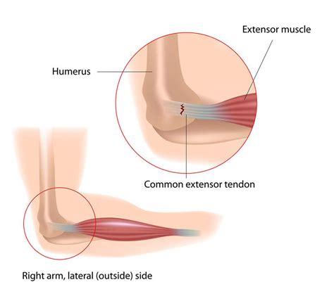 Flexor Tendonitis Of The Elbow: Anatomy, Symptoms, Causes Treatments ...