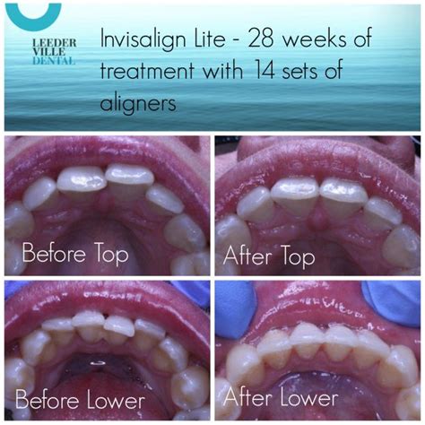 Invisalign Lite - before and after - Leederville Dental - Perth's most ...