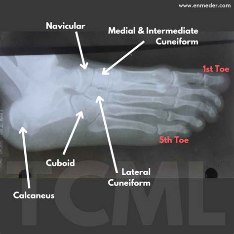 Tarsal bone - TCML - The Charsi of Medical Literature