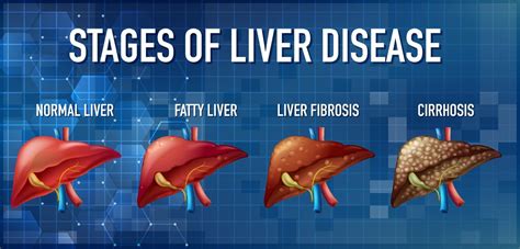 Liver Cirrhosis Stages