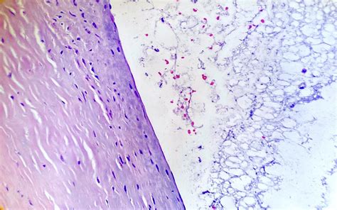 Ganglion Cyst Histology