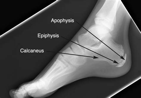 How To Reduce Heel Pain From Sever's Disease