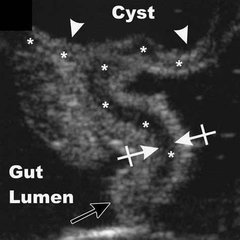 Sonographic Pitfalls in the Diagnosis of Enteric Duplication Cysts | AJR