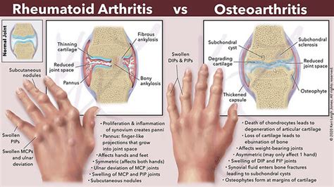 Rheumatoid Arthritis vs Osteoarthritis | Keri Leigh Biomedical Creations