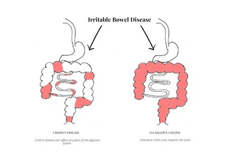 The E-coli Strain 'Nissle 1917' (Mutaflor) A Powerful Probiotic