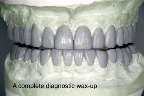 Technical Steps to Produce a Diagnostic Wax-Up - Spear Education