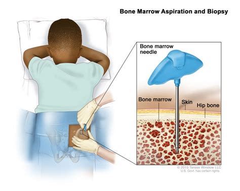 Neuroblastoma Treatment - NCI