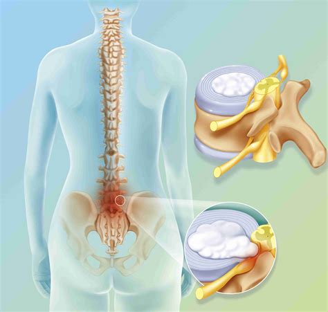 Herniated Disc In Neck Surgery - Bulging Disc vs. Herniated Disc ...