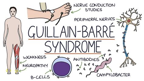 Understanding Guillain-Barré Syndrome - YouTube