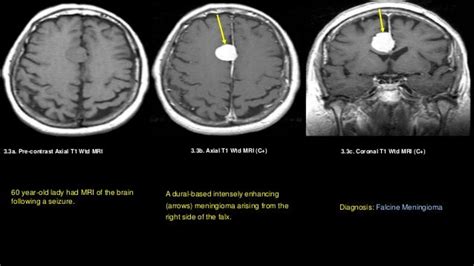 Meningioma falcine and parasagittal