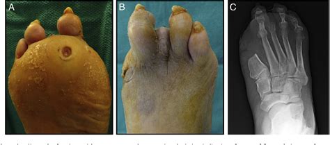 Figure 1 from Plantar rotational flap technique for panmetatarsal head ...