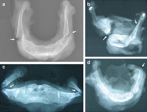 X-ray views of hyoid bone with fractures after fatal trauma on the ...