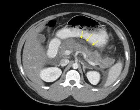 Cureus | Acute Pancreatitis and Prognosticating Its Severity in Young ...