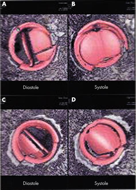 Blockage of bileaflet mitral valve prosthesis imaged by computed ...