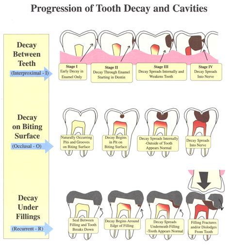 Collection 102+ Pictures Stages Of Tooth Decay Photos Completed