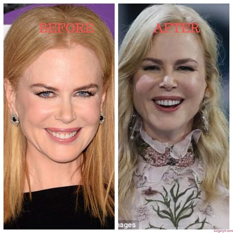 Nicole Kidman Plastic Surgery Photos [Before & After] - Surgery4