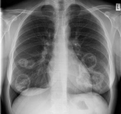 Chest radiograph showing multiple cavitating lung lesio | Open-i