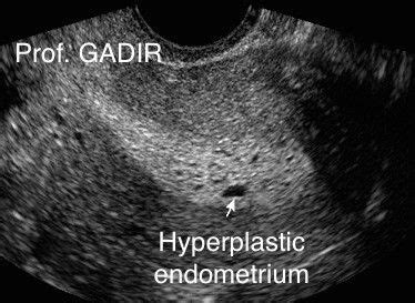 Hyperplastic endometrium | Ultrasound sonography, Medical ultrasound ...