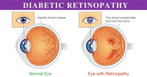 Diabetic Retinopathy Stages: How it's treated? - sriramakrishnahospital