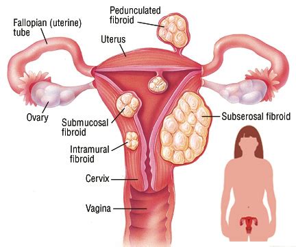 Minimally Invasive Fibroid Surgery in Dubai - Doctor Alphy