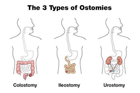 The 3 Types of Ostomies | Hollister US #Colostomy | #Ileostomy | # ...