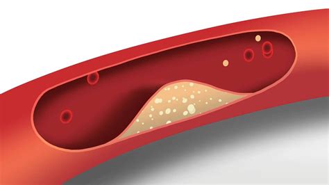 Hypertension Animation