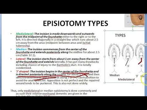 Obstetrics 669 d Episiotomy Types Different Compare Difference Median ...