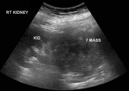 Kidney Tumor Ultrasound