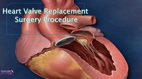 Heart valve replacement surgery procedure