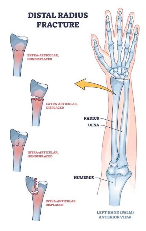 Signs of Wrist Fracture After a Car Accident | Law Offices of Gary ...