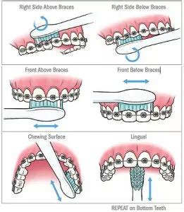 How to brush your teeth with Braces - McSurdy Orthodontics